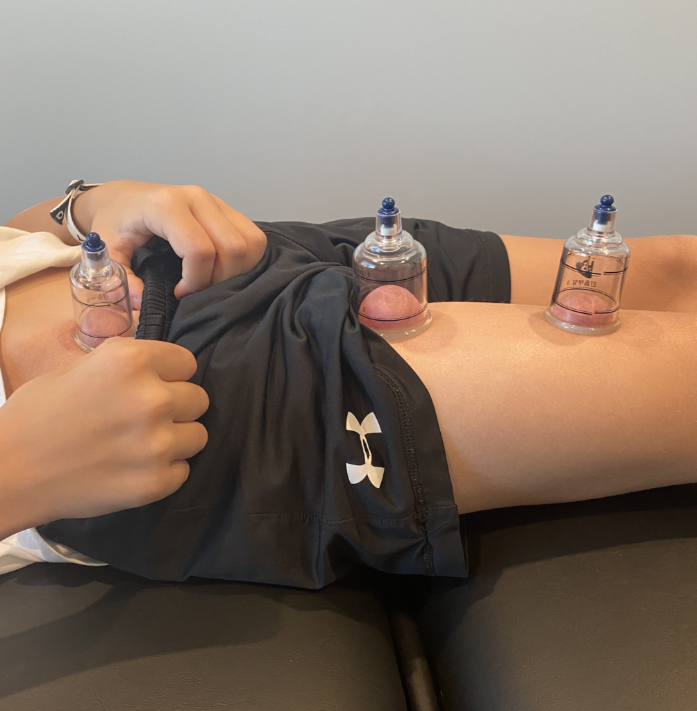Young athlete receiving cupping therapy